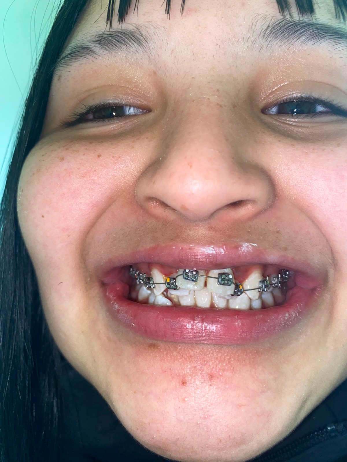 Brackets Convencionales